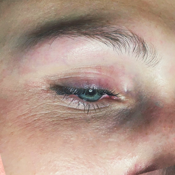 Eyebrow treatment 1 before